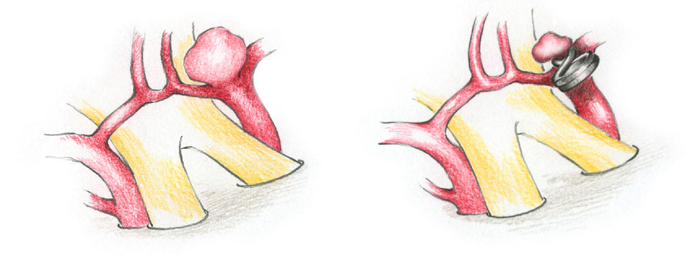 Aneurysma der Teilungsstelle der Arteria carotis interna