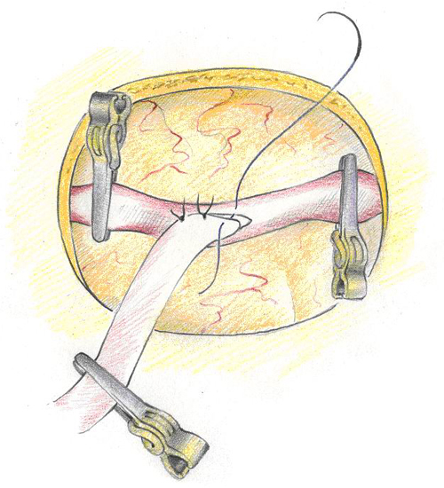 Zeichnung intrakranieller Gefäßverschluss