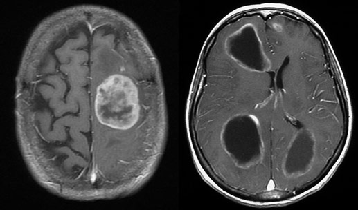 Radiologisches Bild Gehirn: Metastasen