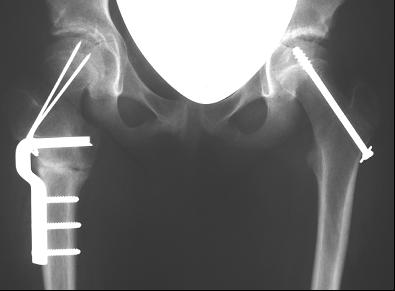 Röntgenbild des Hüftknochens