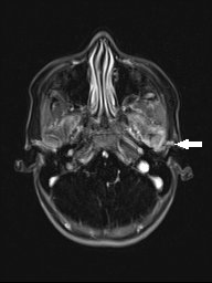 Floride Kiefergelenksarthritis rechts mit Erguss und geringer Deformität des Kieferköpfchens