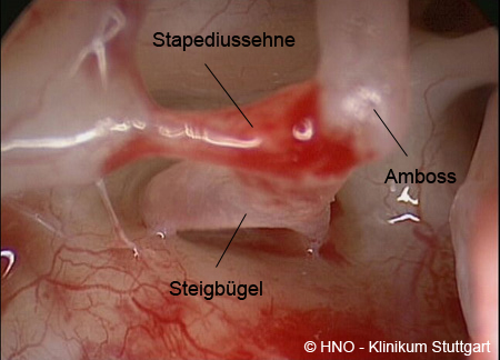 Endoskopischer Blick ins Mittelohr