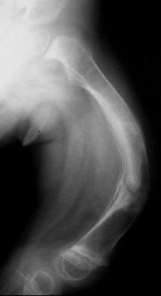 Osteogenisis Röntgenbild