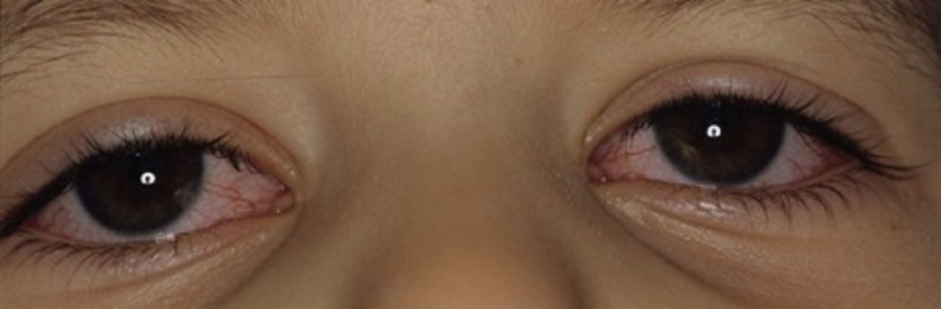 nicht-eitrige Augenentzündung