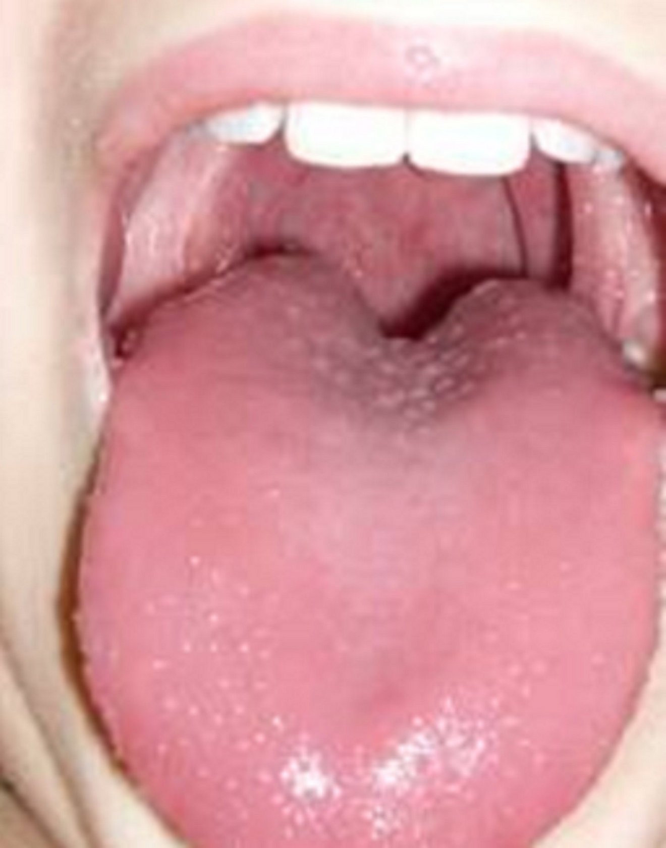 hochrote, rissige und Schwellungen an der Mundhöhle, Erdbeerzunge