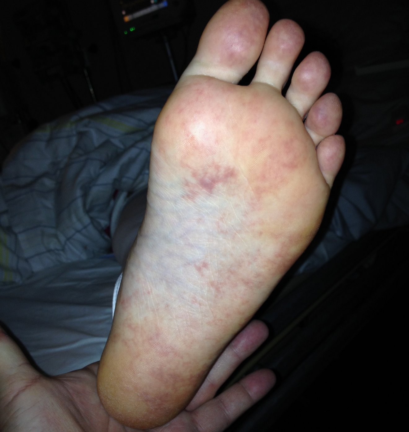 Lupus erythematodes am Fuß