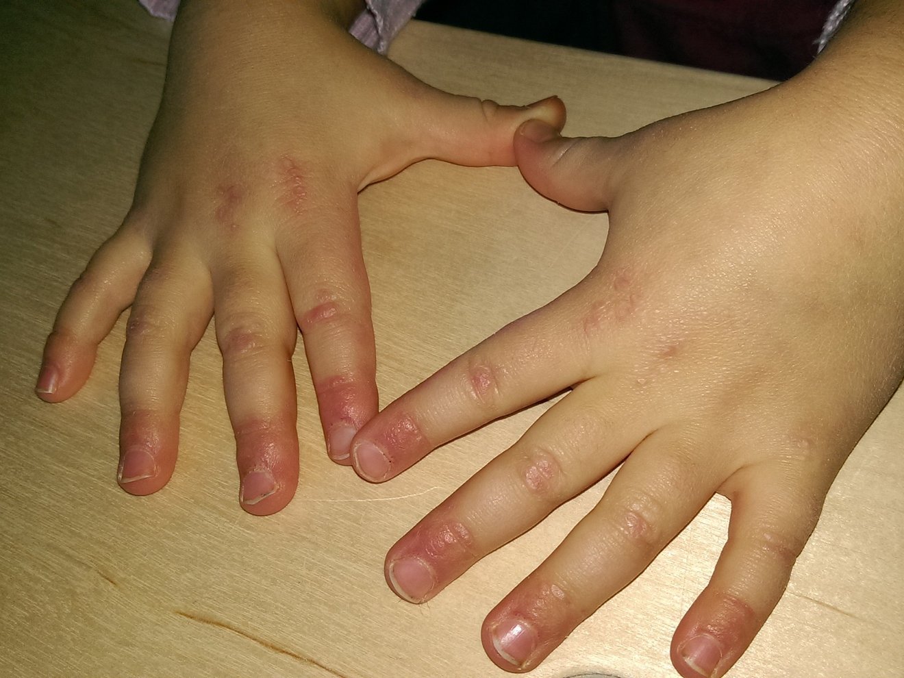 Dermatomyositis an den Fingern