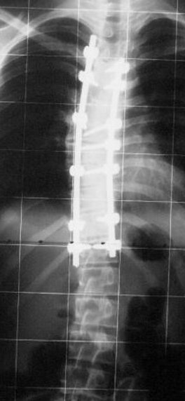 Röntgenbild Korrekturoperation Skoliose