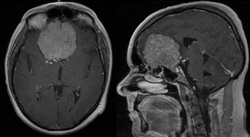 Radiologisches Bild Gehirn: Meningeom