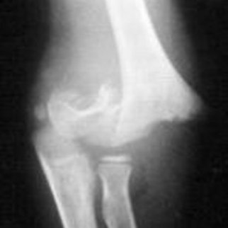 Röntgenbild eines Knochenbruches