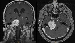 Radiologisches Bild Gehirn: Neurinom