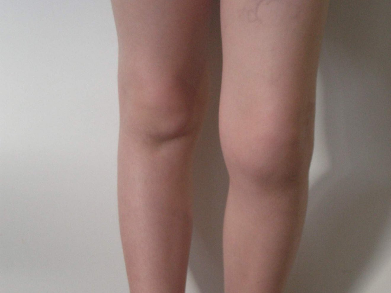 Knie-Gelenk-Entzündung