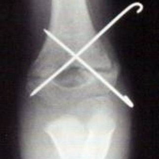 Röntgenbild eines operierten Knochenbruches