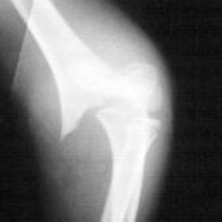 Röntgenbild eines Knochenbruches