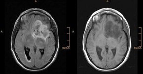 Radiologisches Bild Gehirn: Glimm