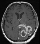 Radiologisches Bild Gehirn: Glioblastom