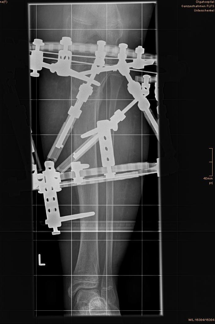 Extremitätenrekonstruktion Röntgenbild