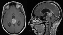 Radiologisches Bild Gehirn: Pinealis