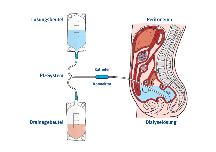 Bauchfelldialyse (Peritonealdialyse)